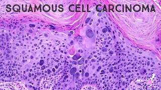 Squamous cell carcinoma in situ with massive pleomorphism pathology dermpath dermatology USMLE [upl. by Lilak]