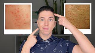 How to Get Rid of Acne Scars [upl. by Suoivart]