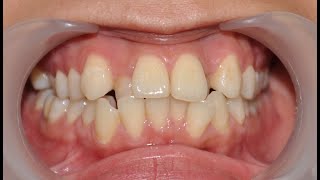 27 yo  Crowding teeth Dientes Desalineados Orthodontics Treatment Braces [upl. by Kali]