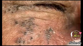 Dr Pop  Deep Blackheads in old Skin removing amp treatment 2020 Part 5 [upl. by Dumah]