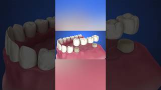 Tooth supported fixed bridge instalation process medicalanimation health dentist [upl. by Felicle]