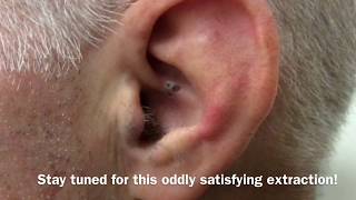 Ear Blackhead Extraction  Dr Steven Greene in Seattle [upl. by Aehtna762]