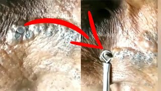 blackheads on old skin  Satisfying Videos [upl. by Asital]