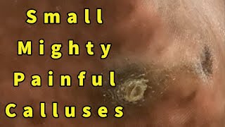 Small Mighty Painful Calluses Intractable Plantar Keratoses Removal  Repost [upl. by Lebna118]