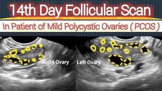 14th Day Follicular Scan  in Patient of Mild Polycystic Ovaries  PCOS [upl. by Ezitram717]