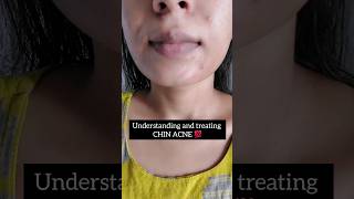 Having Acne on Chin acne hormonalacne acnetreatment acneproneskin acneskincare skincare [upl. by Patrick]