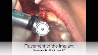 Implant placement in the incisive canal [upl. by Levenson]