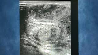 Testicular Abscess Complicated EpididymoOrchitis infection medical health ultrasound trending [upl. by Nuahc]