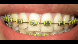 Braces Update  24 [upl. by Eioj845]