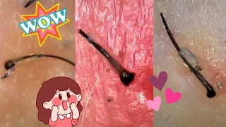 Big Juicy Follicle Hair Plucks Super Satisfying Root Extractions Under The Microscope [upl. by Eniledam926]