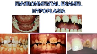 ENVIRONMENTAL ENAMEL HYPOPLASIA  DEVELOPMENT DISTURBANCE IN THE STRUCTURE OF TEETH [upl. by Yruok]