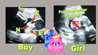 22 wk Fetal heartbeat anomaly ultrasound  Fundal Anterior placenta means baby boygirl  pregnancy [upl. by Nonah25]