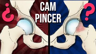 Cadera CAM y PINCER ¿qué son y por que se producen [upl. by Cuyler441]