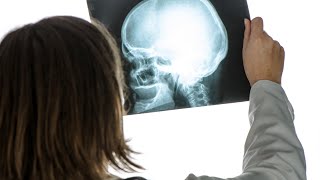 Le traumatisme craniocérébral une blessure sournoise [upl. by Teragram]