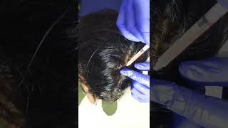 Female PRP Hair growth Dermapen Treatment [upl. by Norraj608]