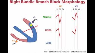 Left Bundle Branch Block and Right Bundle Bundle Branch Morphology [upl. by Gnem]