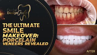 The Ultimate Smile Makeover Porcelain Veneers Revealed [upl. by Chang]