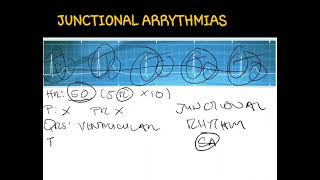 ECGJunctional Arrythmias [upl. by Palmer248]