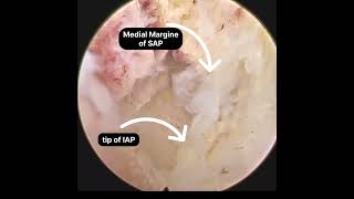 L4L5 interlaminar Endoscopic Decompression Contralateral over the top decompression [upl. by Nitsirhc]