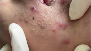 Acne treatment under the skin  p1 [upl. by Enawd]