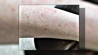 Seborrheic Keratosis What Is It amp How to Treat It [upl. by Sabah462]