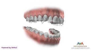 Orthodontic Retainer  Hawley  Instruction and Care [upl. by Lleon]