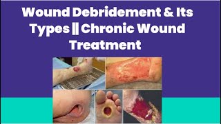 Wound Debridement amp Its Types  Chronic Wound Treatment  PhysiotherapyKnowledge [upl. by Llenrahc]