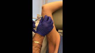 Surgery in a Syringe℠ Contouring the Arms with Kybella while Awake [upl. by Asirak374]