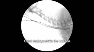 Veterinary Bronchoscopy584 Tracheal Stent Placement for Primary Tracheal Collapse in dog [upl. by Erick]