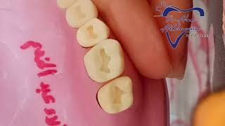 class 1 cavity preparation for upper 6 for amalgam restoration  شرح بسيط ومفصل بالعربي [upl. by Longley350]