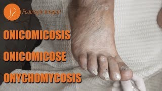 Fungus  Onychomycosis podology asmr [upl. by Alonso]