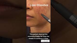 LIPODISSOLVE FAT DISSOLVING MESOTHERAPY INJECTION  CHUBBY CHEEKS [upl. by Elleval]