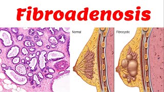 4 Fibrocytic Disease  Fibroadenosis [upl. by Dupaix]