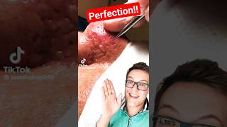 Stunning BLACKHEAD REMOVAL  Crazy Satisfying shorts [upl. by Aronle]