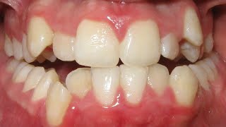 HOW BRACES WORK timelapse of extraction treatment in severe crowding case Before and After [upl. by Aia]