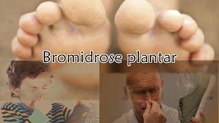 Bromidrose Plantar [upl. by Akimad329]