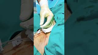 central line insertion steps femoral line insertion procedure central line kaise dalte hain [upl. by Pergrim146]