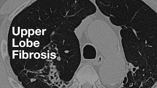 Upper Lung Predominant Fibrosis [upl. by Eiramlatsyrk]