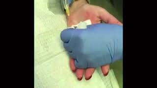 Treatment for Hyperhidrosis  Dr Longwill [upl. by Luht347]