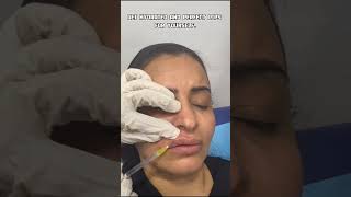 Lip Fillers Treatment Before amp After Procedure Risks and Results in 2024 lipfillers shorts [upl. by Friedly]