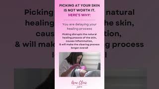 skincare blackheads beauty facial skin skincareroutine esthetician [upl. by Oirtemed]