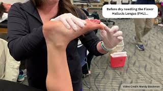 Dry Needling of the Flexor Hallucis Longus FHL [upl. by Enitsej]