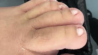 Beautiful Work ❤❤❤❤ Satisfying ingrown toenail removal ❤❤❤❤ funny satisfying 051 [upl. by Cameron190]