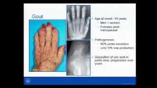 Rheumatology Pearls Dr John M Davis III 82014 [upl. by Bevers]