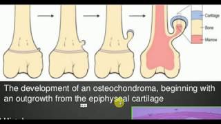 ORTHOPEDICS LECTURES  Tumors  OSTEOCHONDROMA [upl. by Guyer360]