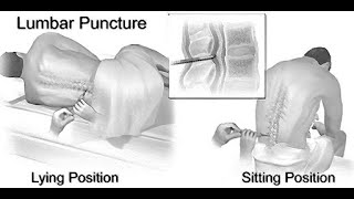 Mnemonics to remember structures pierced during Lumbar Puncture [upl. by Enaira]