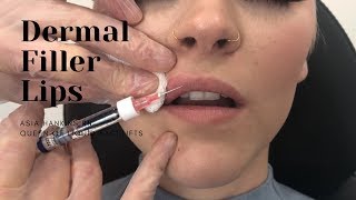 Dermal Filler Lips  1 Syringe RESTYLANE [upl. by Tildi]