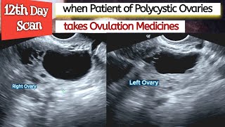 Ovarian CYSTS  Ovulation Medicines in PCOS Patient  Polycystic Ovaries  Infertility [upl. by Rinee]