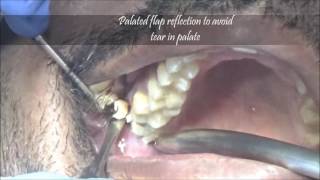 How to remove upper wisdom molar with cryer elevatorsteps [upl. by Krutz876]