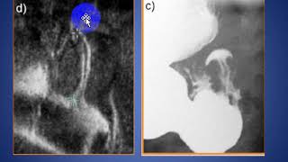 Hypertrophic Pyloric Stenosis ULTRASOUND [upl. by Leasia]